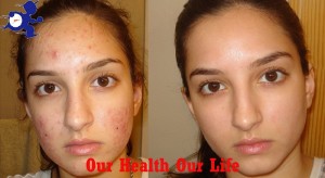 Know the great way of eliminate acne at one night (With video)