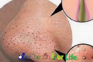 How to get rid of blackheads on nose and face