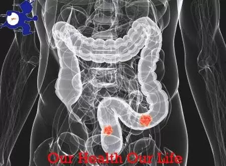 symptoms of colon cancer