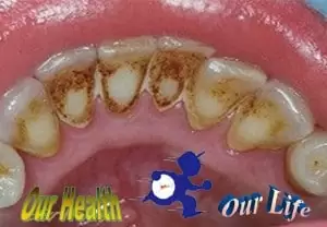 How I can remove plaque and improve my oral health?