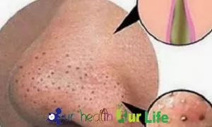 How to get rid of blackheads on nose and face